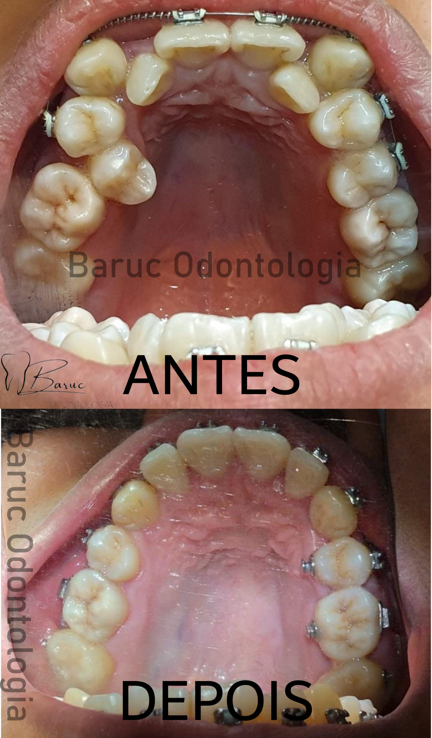 caso aparelho dental